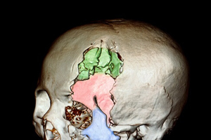 scan of a traumatic brain injury