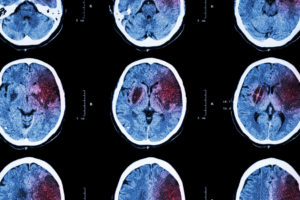 ct imaging of brain injury